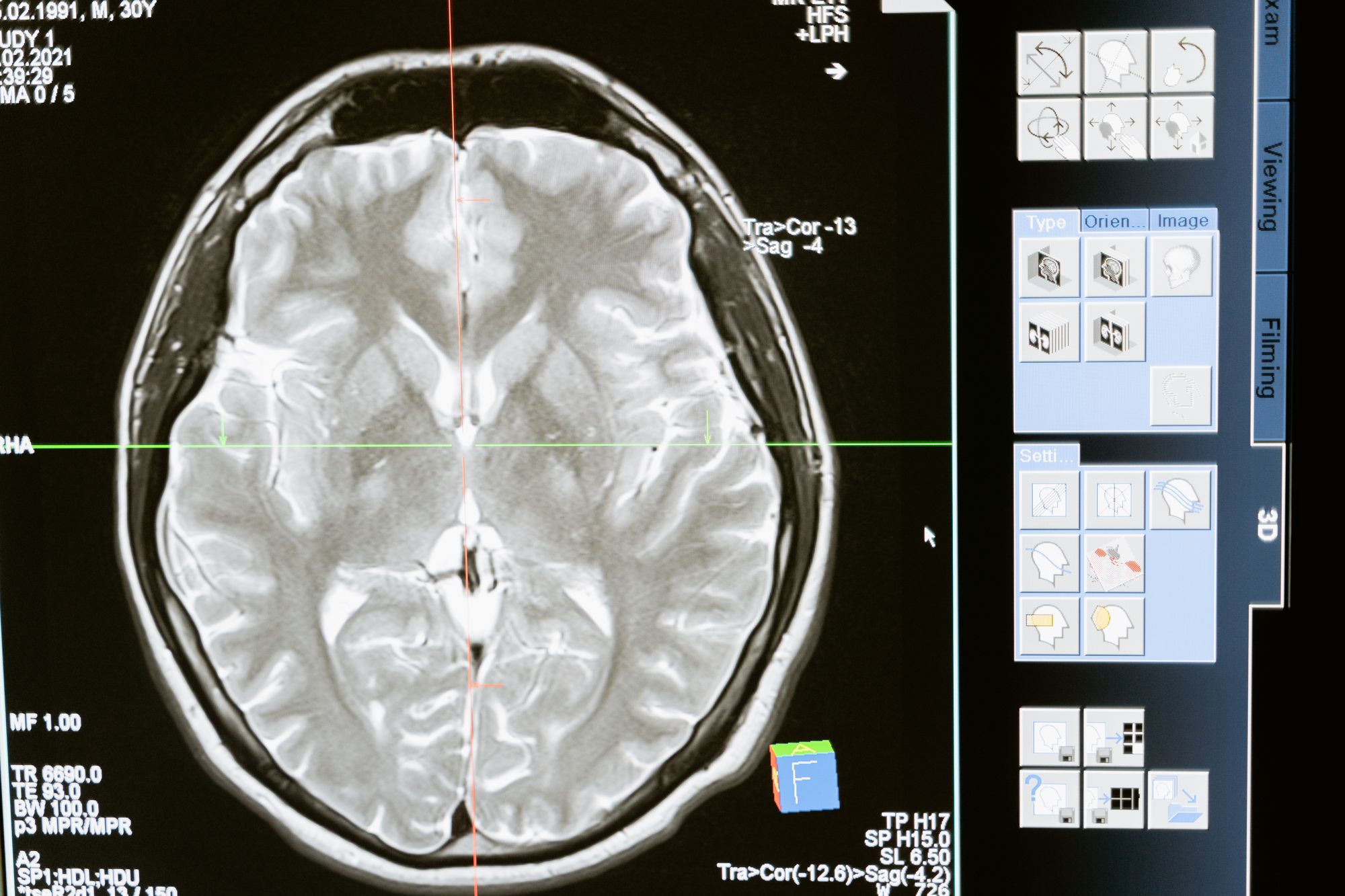 Cerebrum Is 85% of Brain Weight but Cerebellum Has 69 Billion Neurons