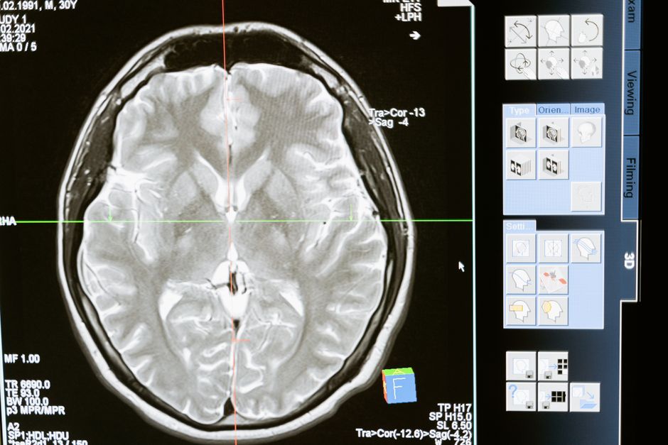 Brain MRI scan displayed on a computer screen — ibogaine works on multiple neurological systems simultaneously