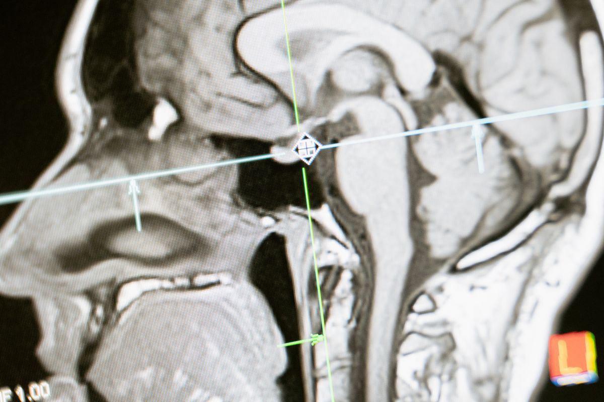 Sagittal brain MRI scan used in the neurological diagnosis of multiple sclerosis