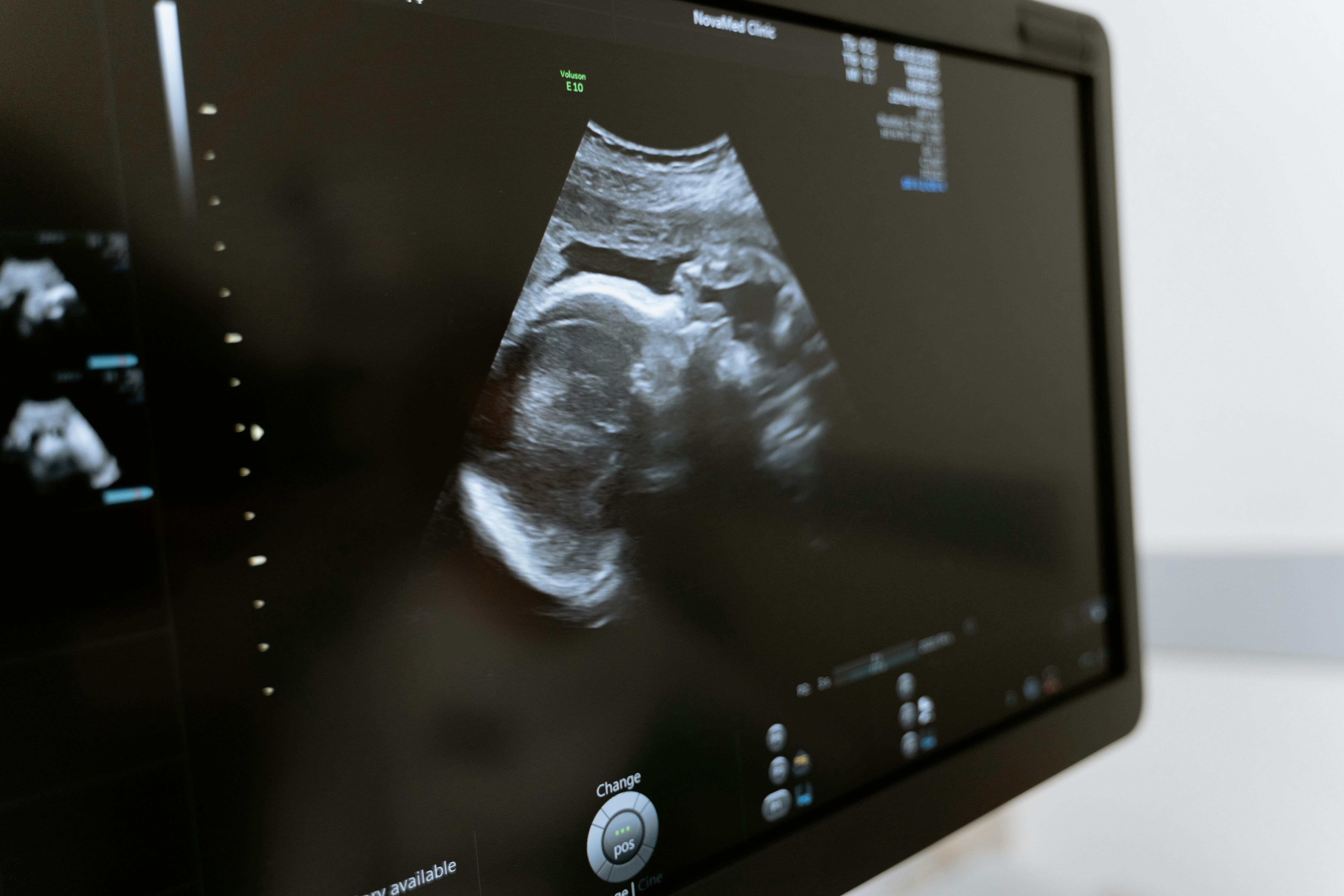 4D ultrasound machine for an elective studio in Georgia