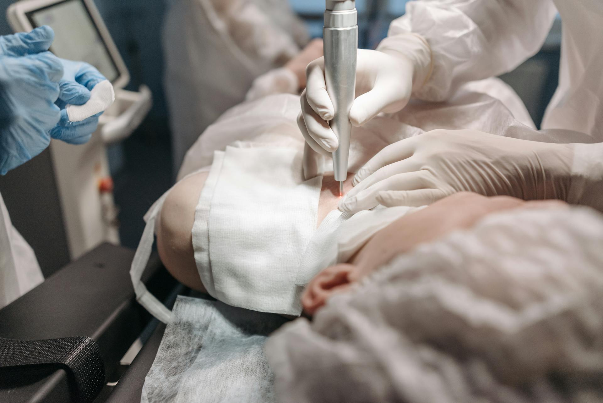 Doctor Removing Mole with Medical Laser Machine