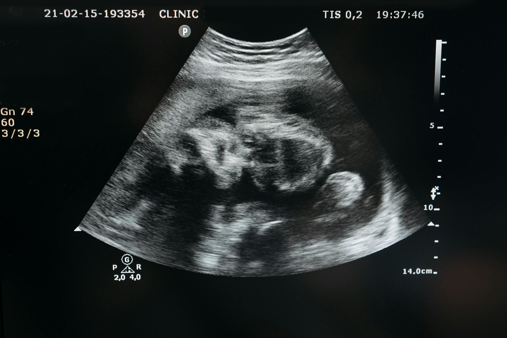 Ultrasound of an Unborn Child