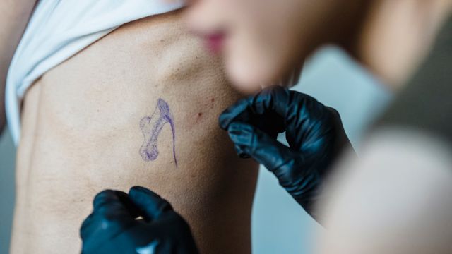 Remoção de Pintas em Jundiaí: Desvendando o Mito da Dor e a Segurança do Procedimento - Augusta Perfection