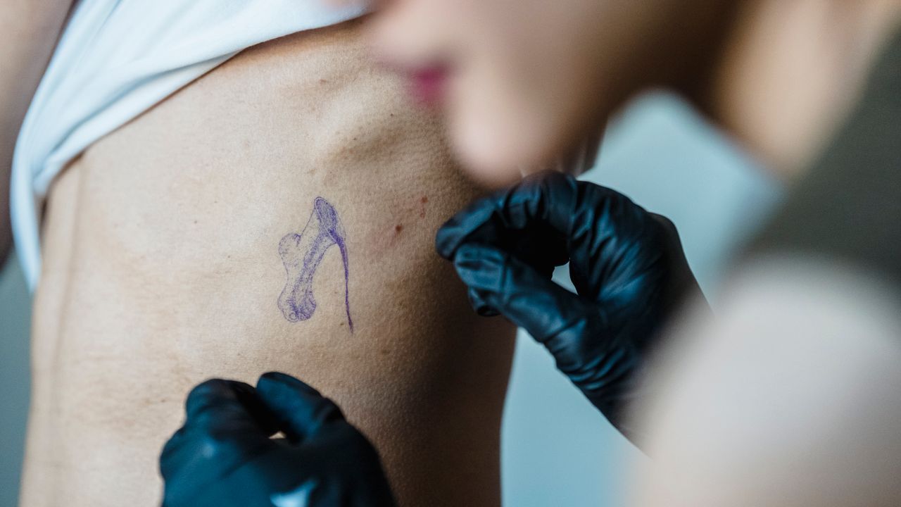 Remoção de Pintas em Jundiaí: Desvendando o Mito da Dor e a Segurança do Procedimento - Augusta Perfection