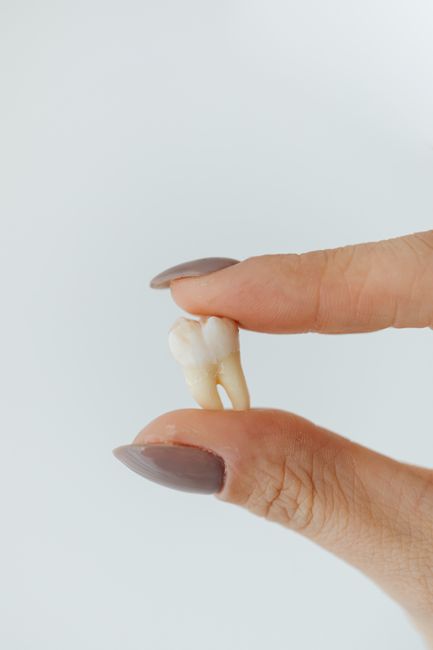 Wisdom Tooth Removal in Bhopal: Complete Guide by Titanium Smiles