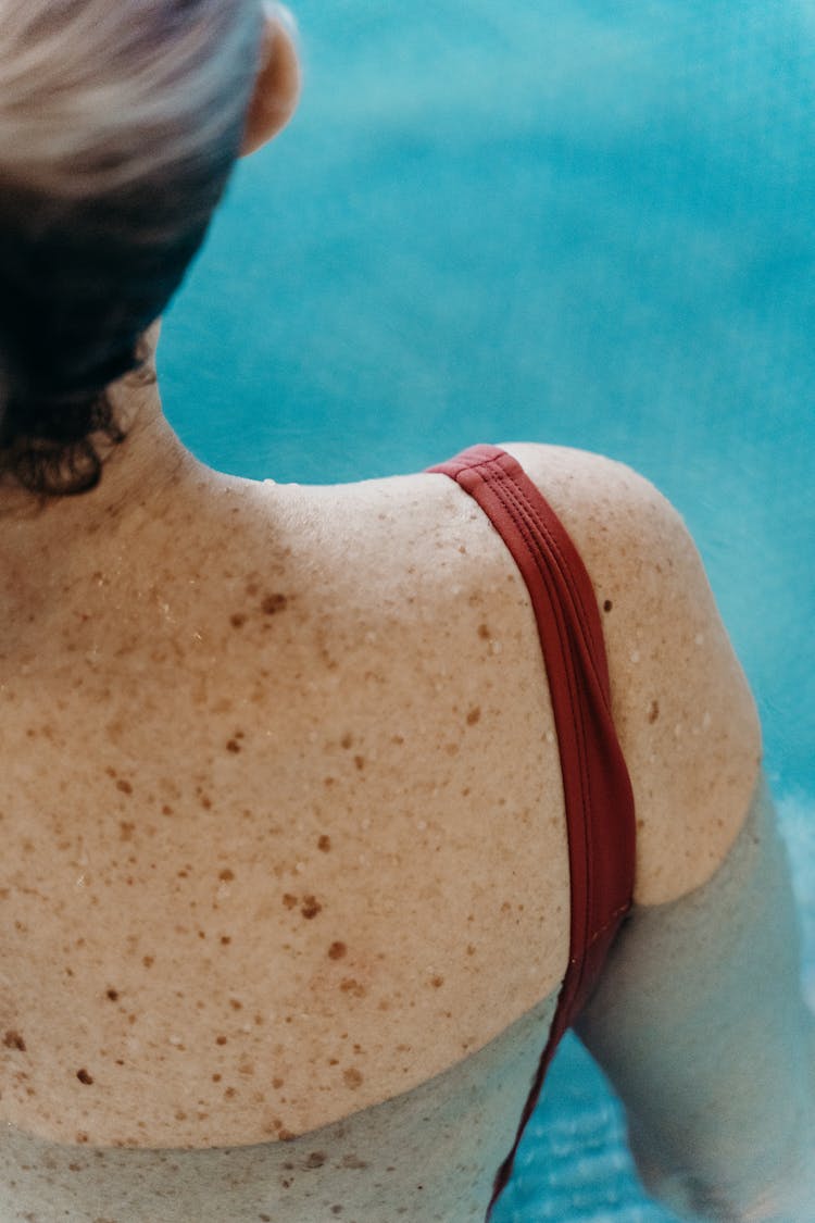 Photograph Of Freckles On A Woman's Back