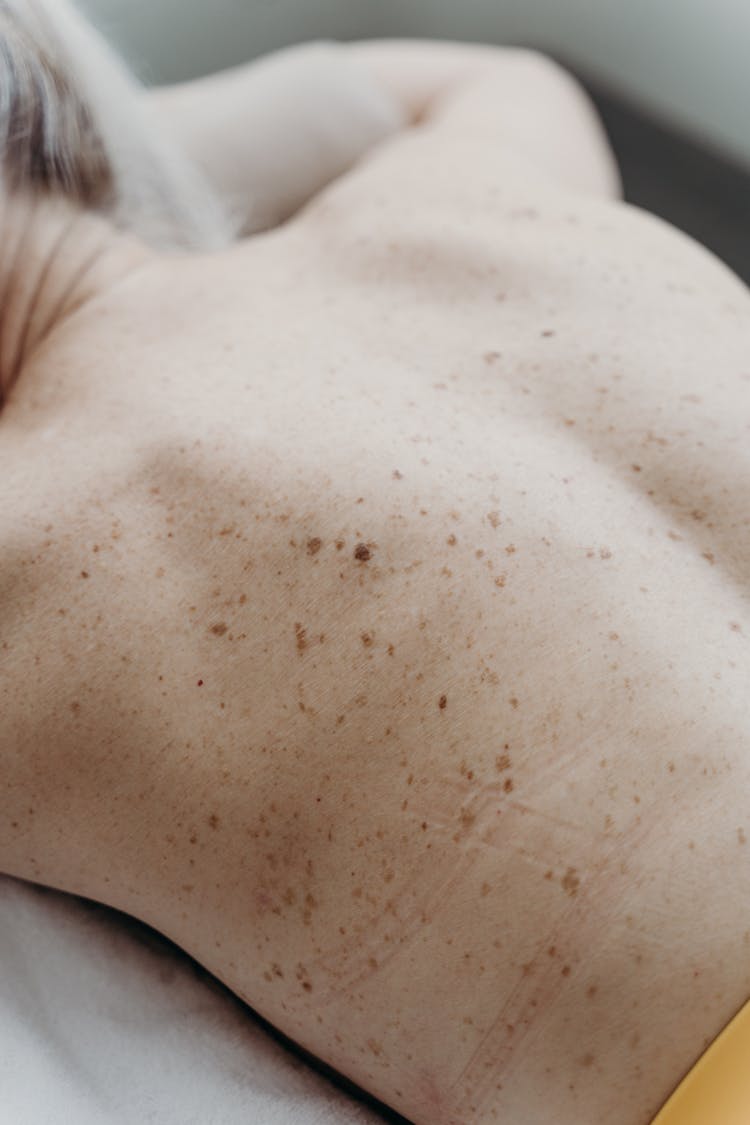 A Person's Back With Freckles And Marks