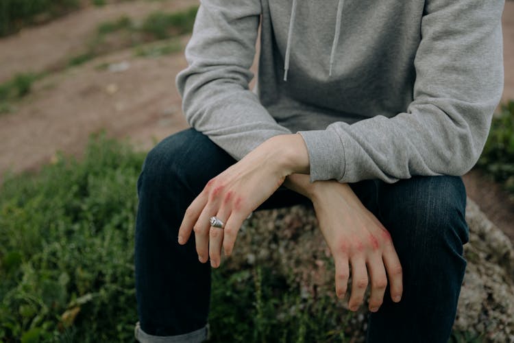 Person With Bruises On His Hands