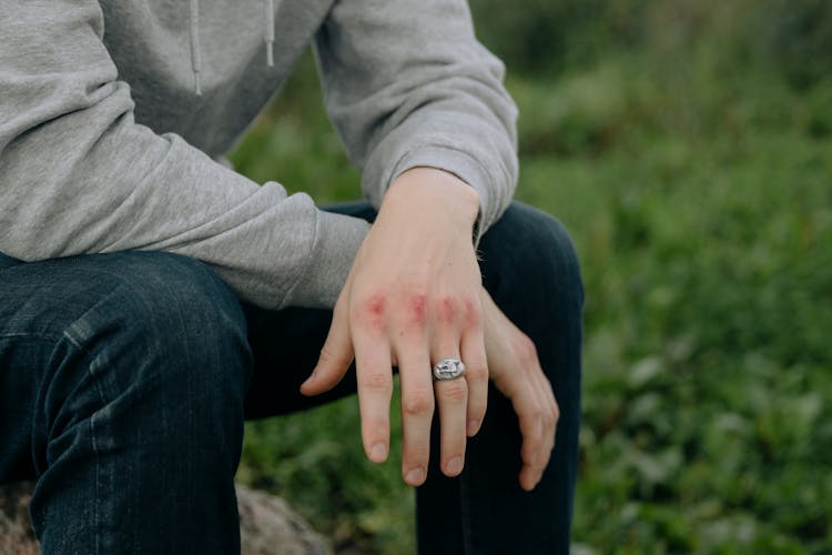 A Person With Bruised Knuckles