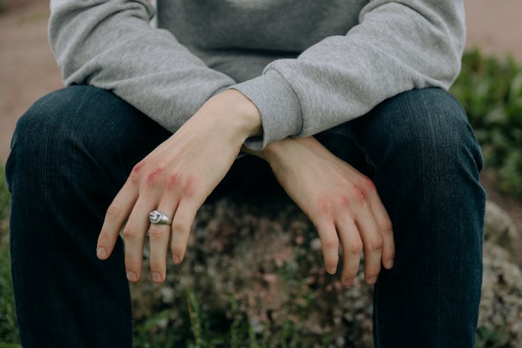 A Person Sitting With Their Knuckles Bruised