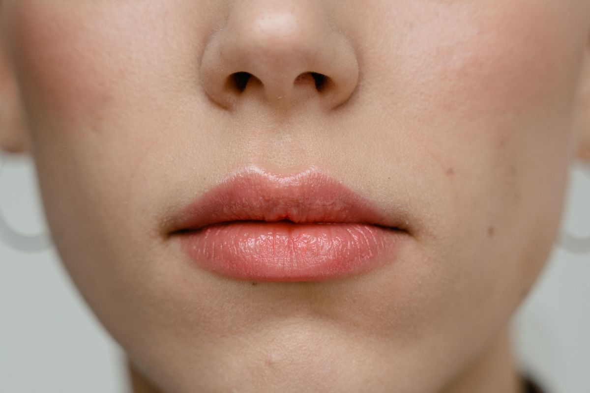 Sculptra treatment at a MedSpa