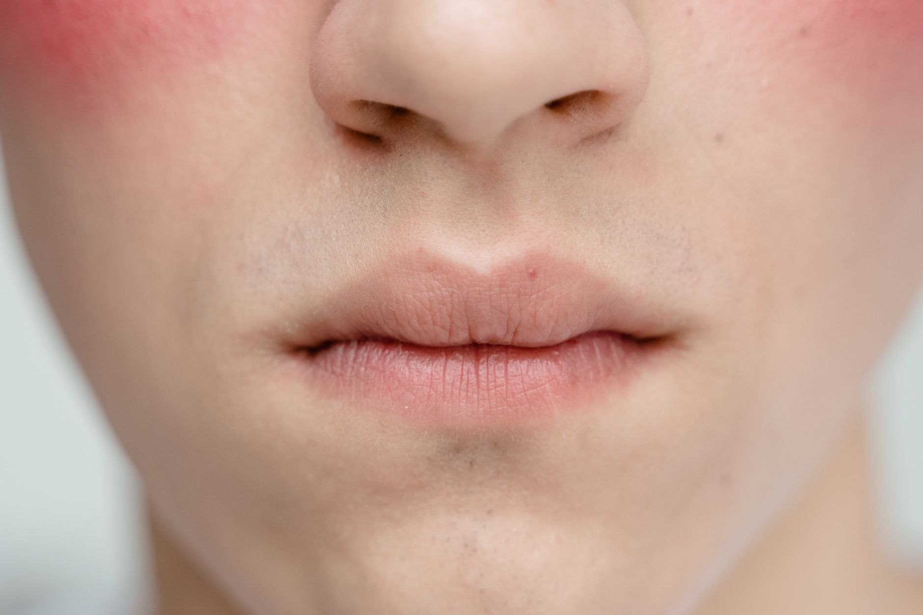 Facial Plethora: Understanding Swelling and Redness in Your Face