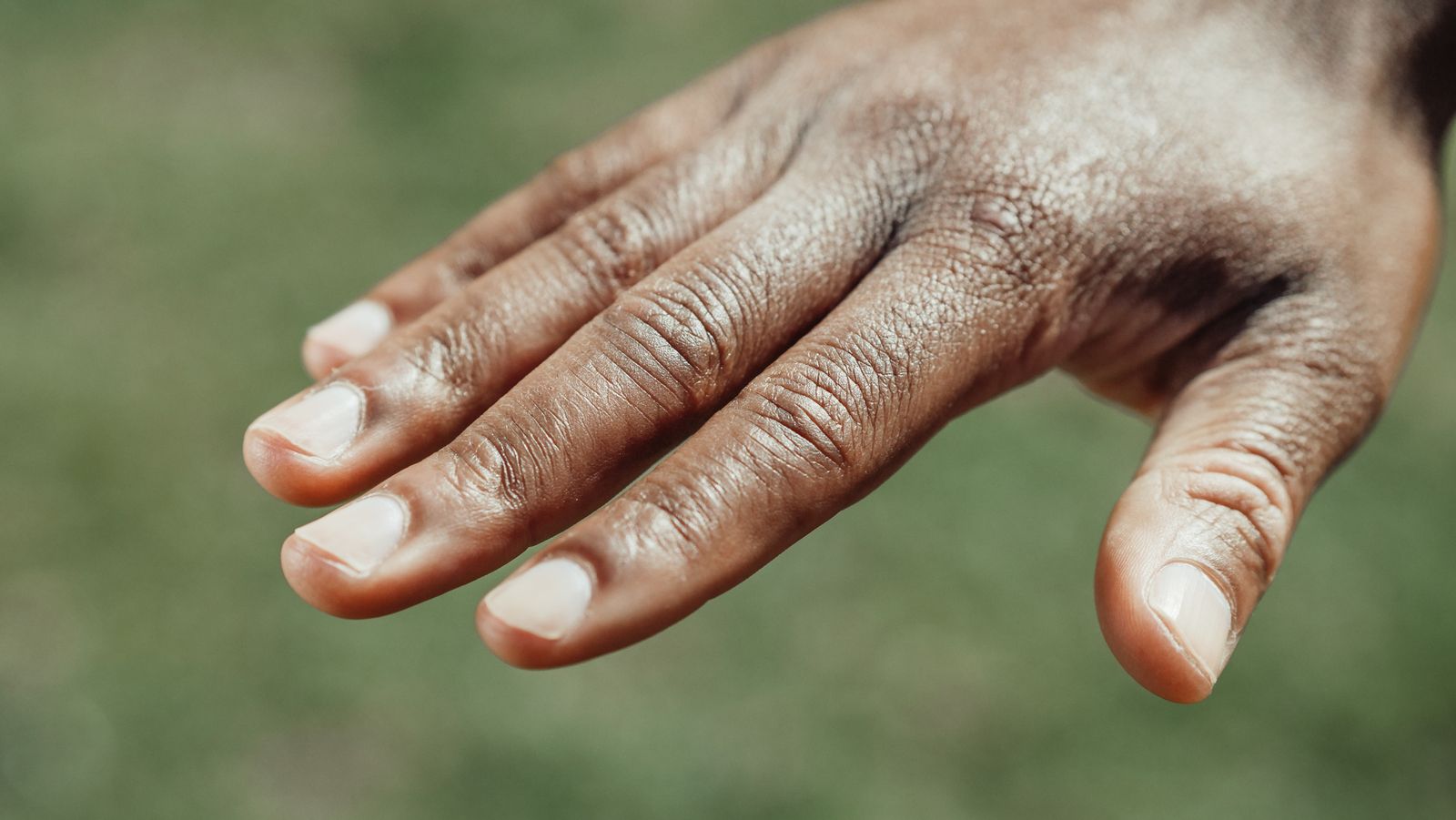 Close-up of natural fingernails and hand representing nail health assessment
