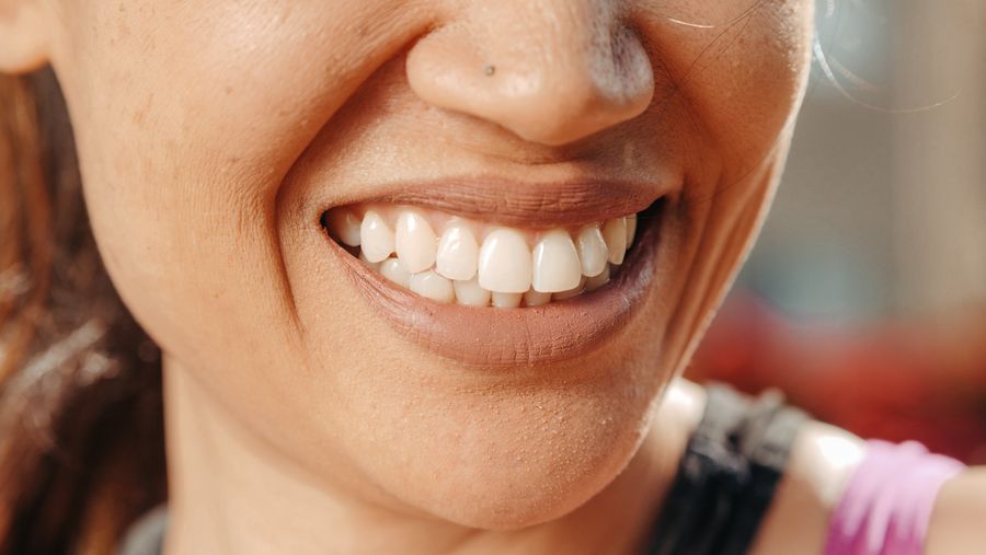 Smile after whitening