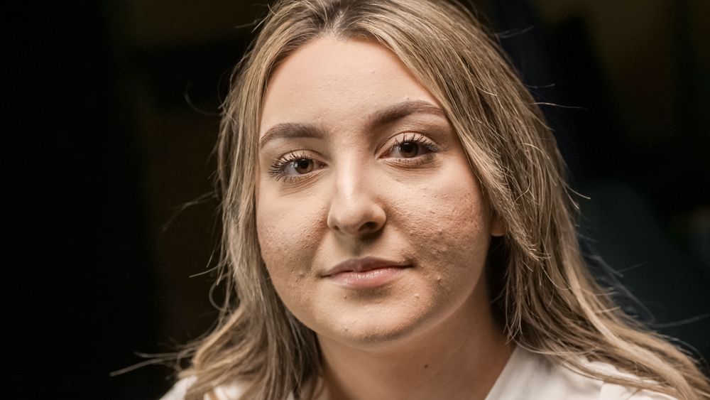 Woman with acne-prone skin