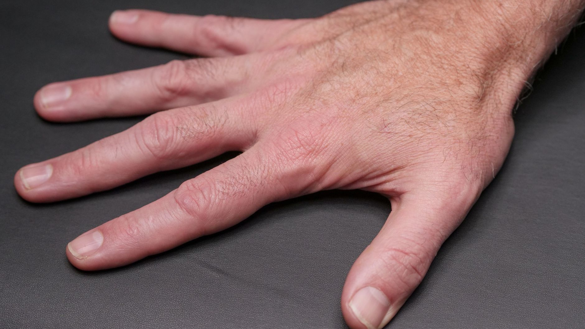 Hypothyroidism and Your Hands: Recognizing the Signs