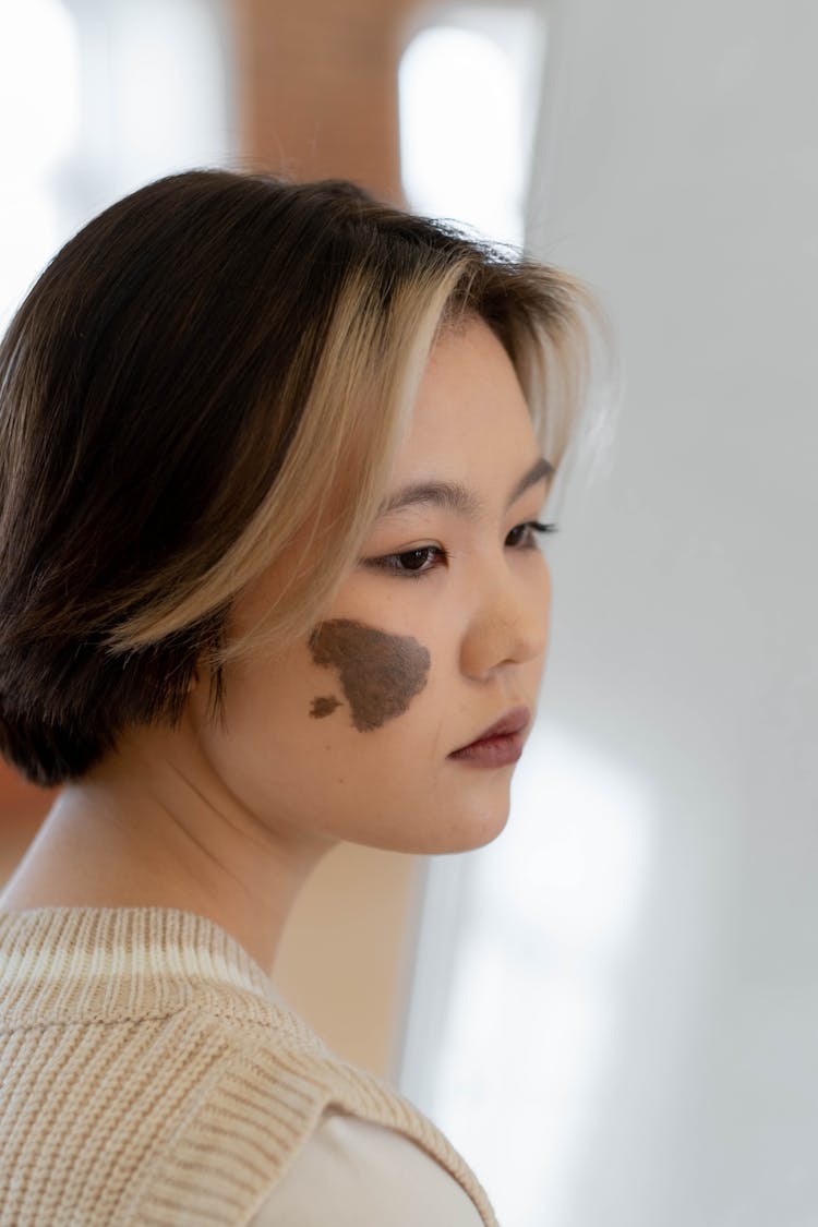 Woman With Birthmark On Her Face 