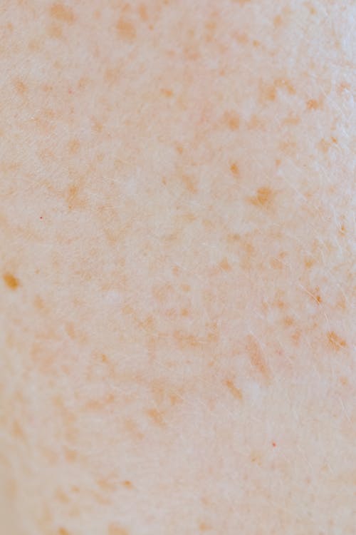 Skin with Freckles