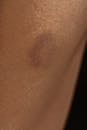 Closeup of crop unrecognizable ethnic person with fleck on soft brown and beige body skin