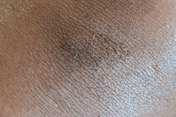 Skin Surface With Pigmentation Spot In Center