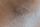 dry skin