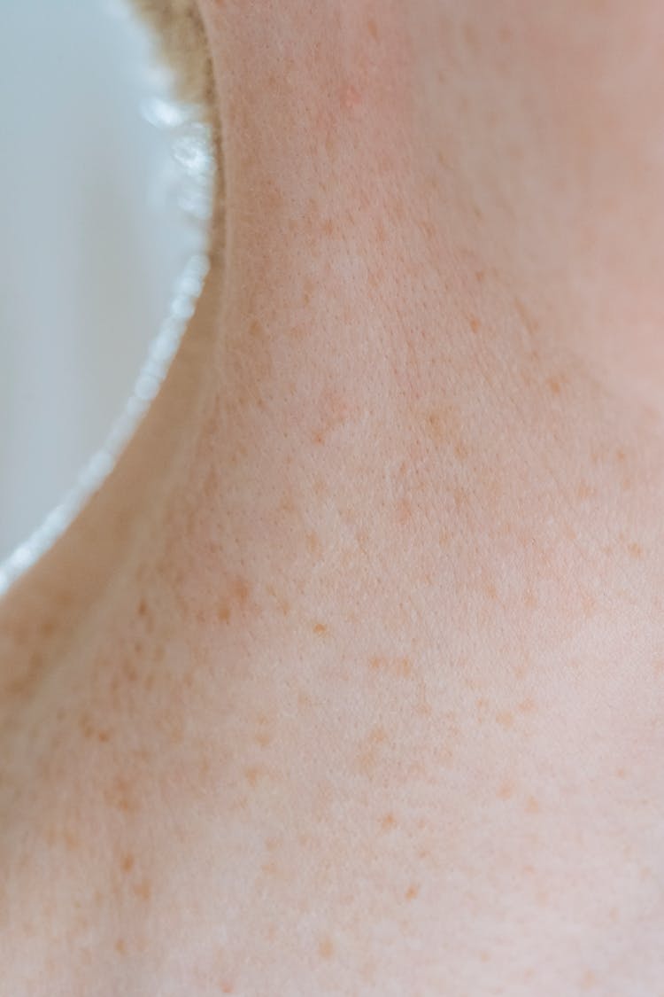 Skin With Brown Spots On Neck Of Crop Person