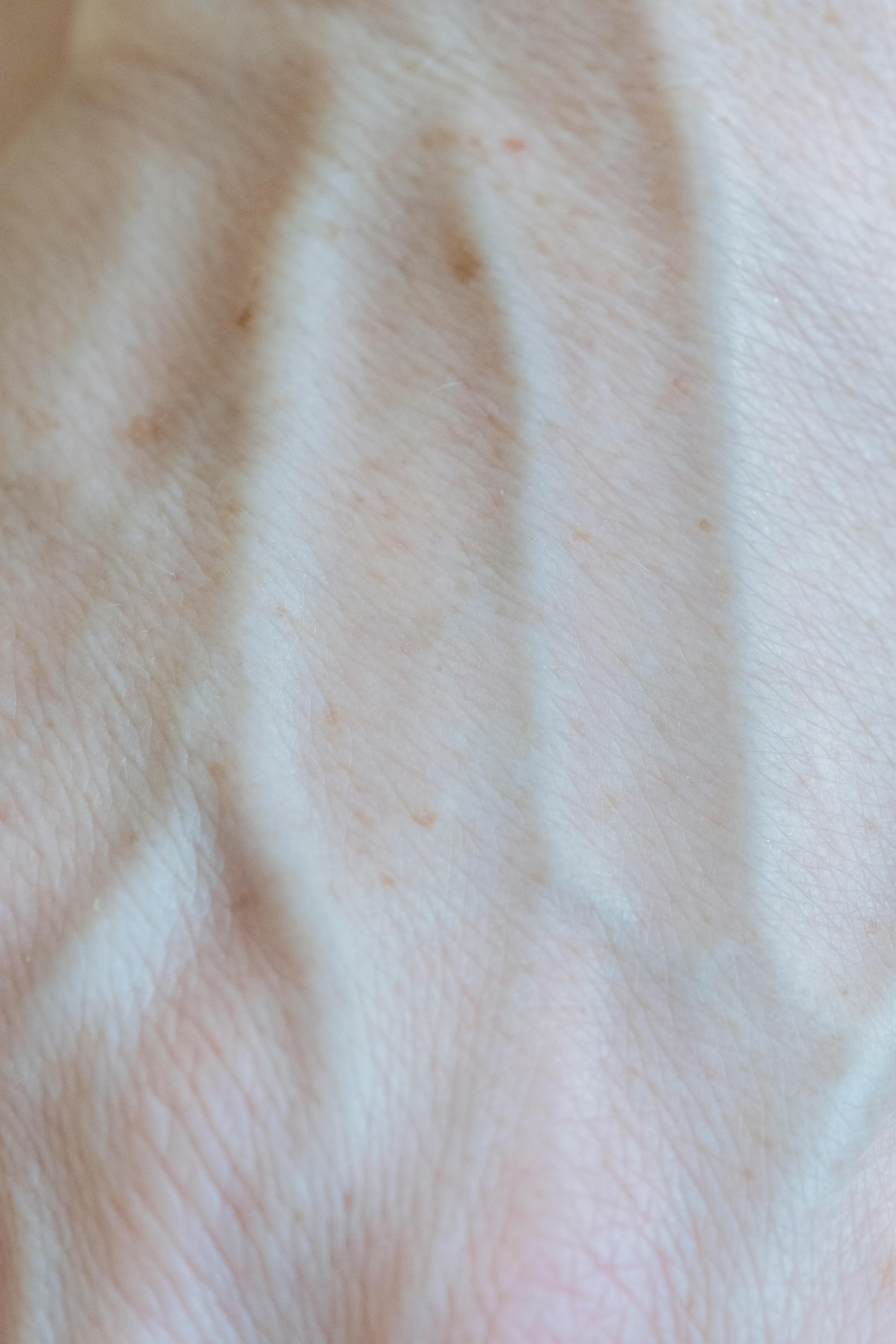 small veins under skin surface