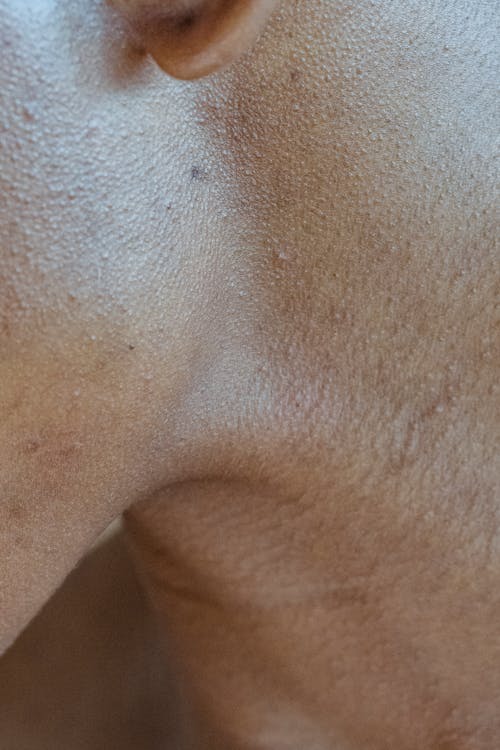 Closeup of neck with freckles and acne of crop unrecognizable person in daylight