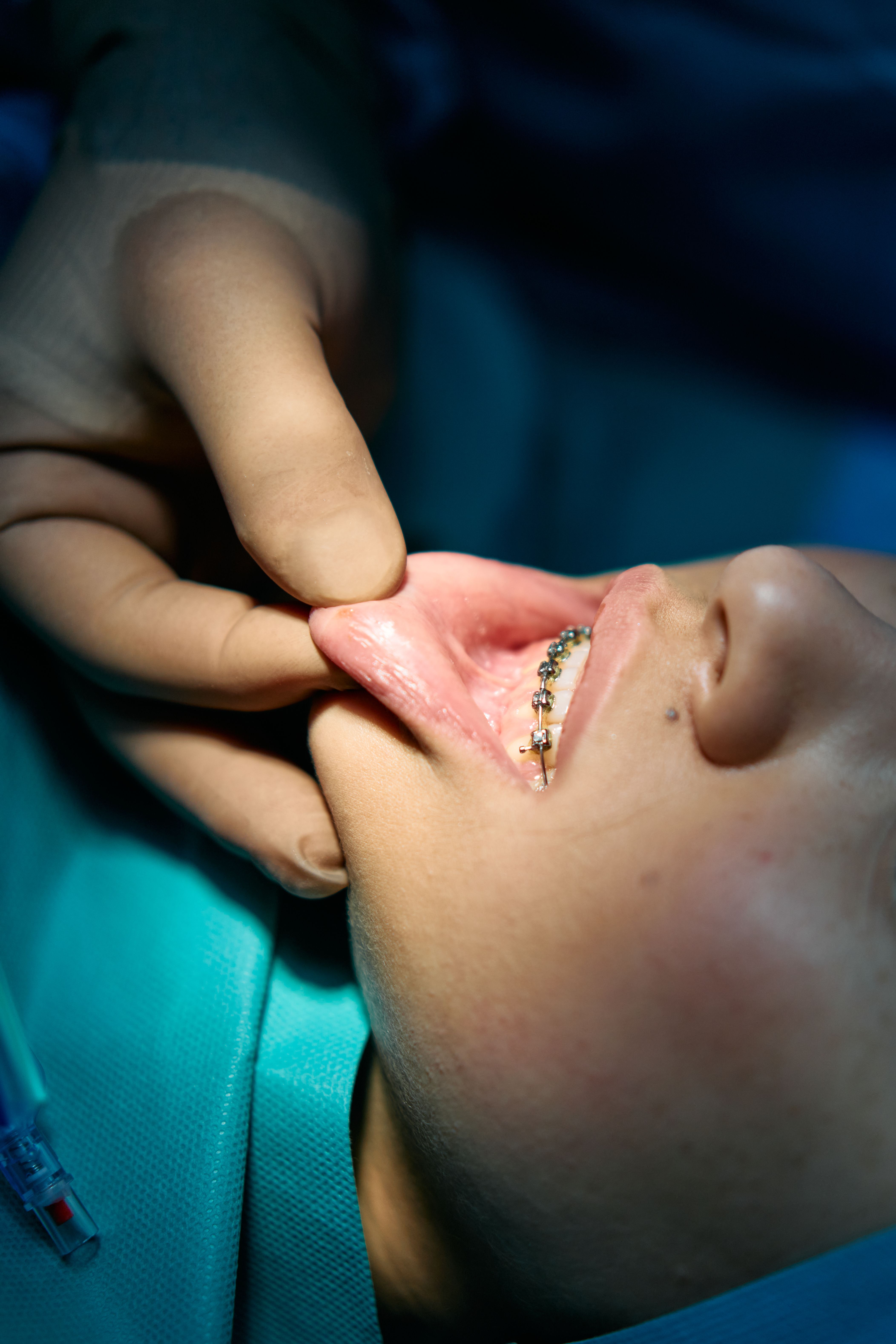 Close-up of a dental examination with braces in a professional clinic.