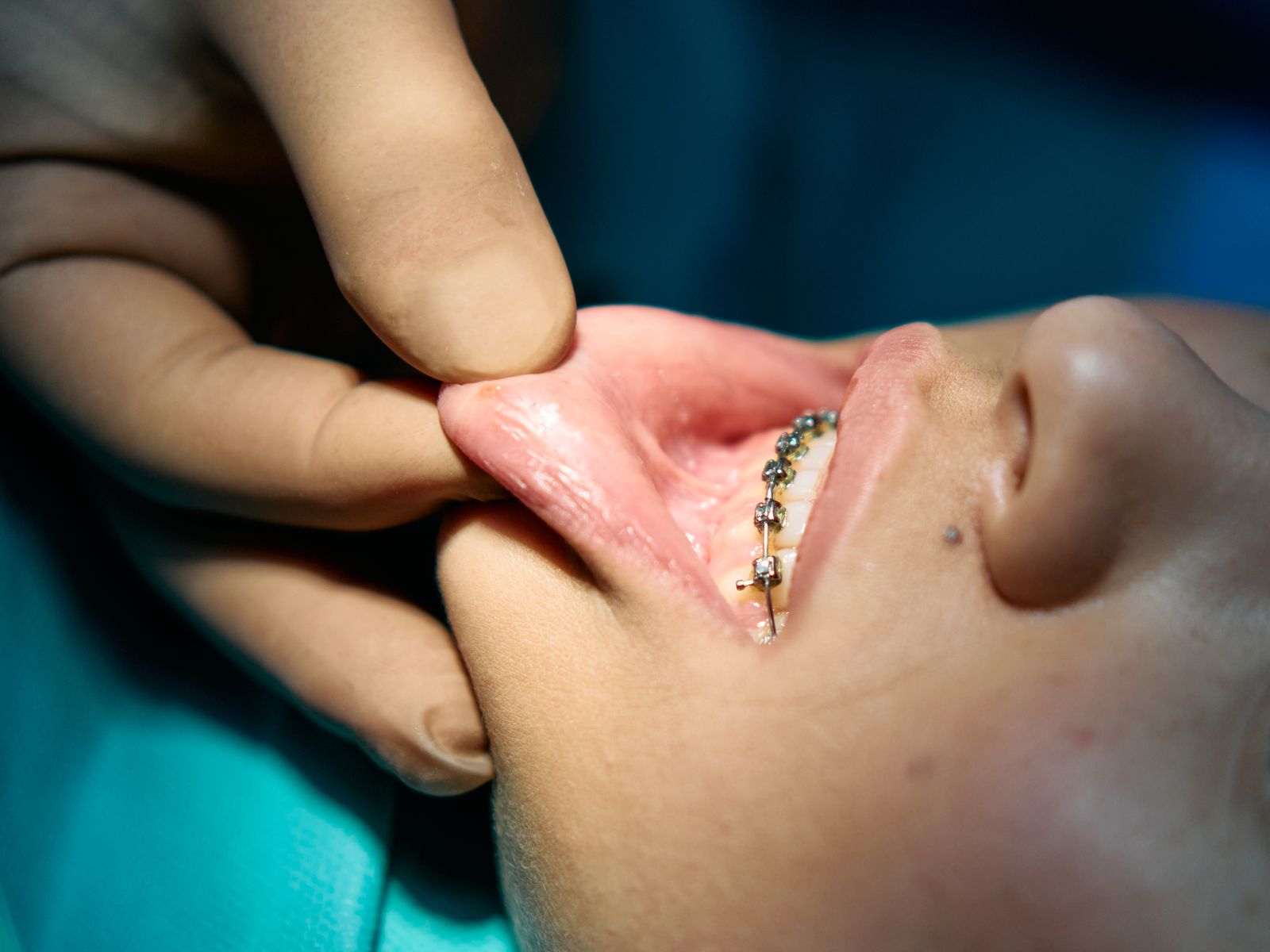 Orthodontic braces being examined in a dental clinic