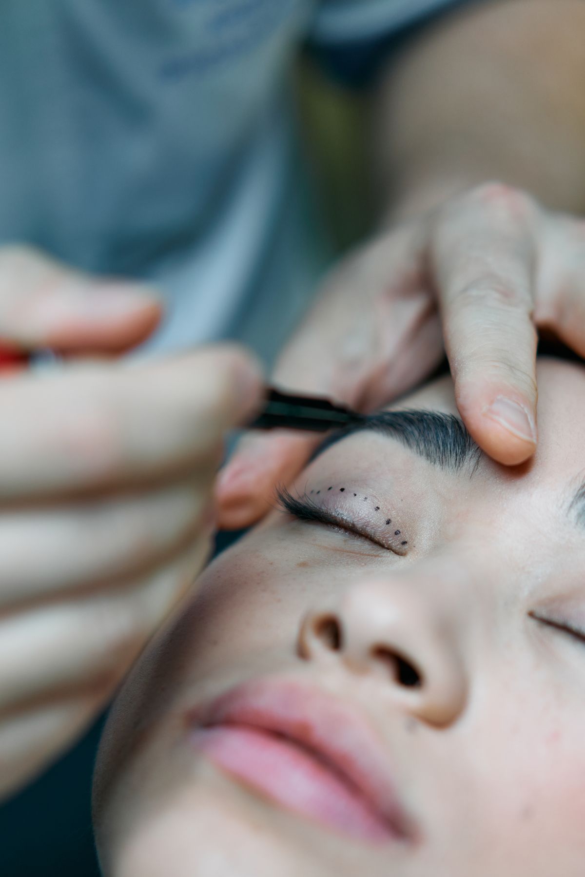 Close-up of a surgeon reviewing marked upper and lower eyelid anatomy before surgery