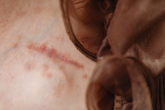 surgical scar healing