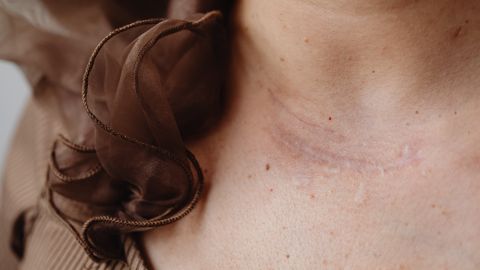 Scar tissue, remodelling and why a healed injury is never quite new