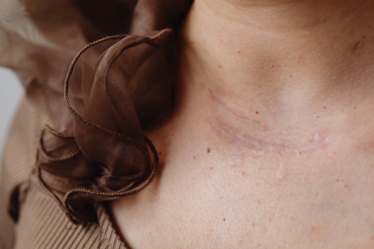 Close Up Of A Scar On A Neck