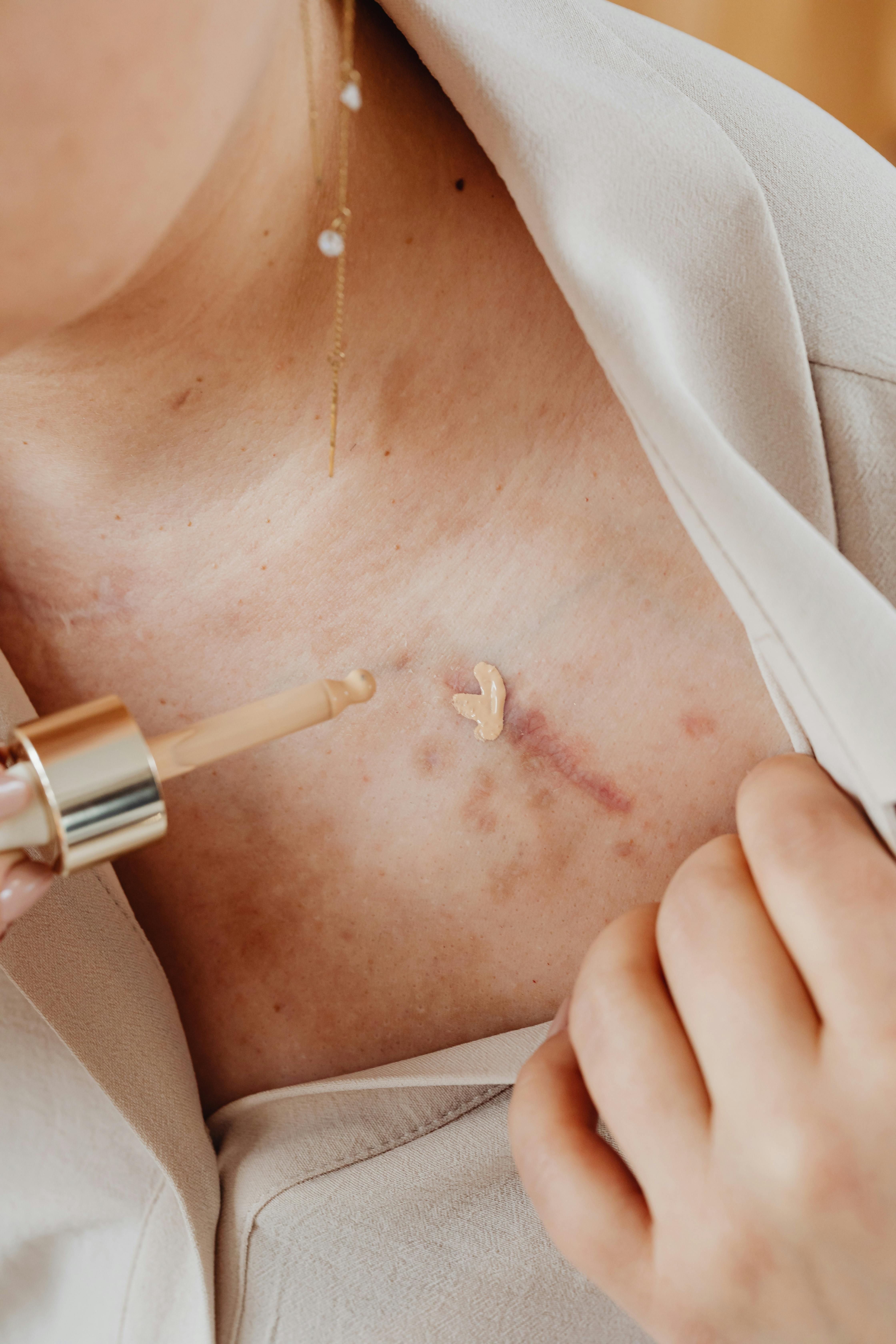 Close-up of a person applying concealer to cover skin scars and bruises using a dropper.