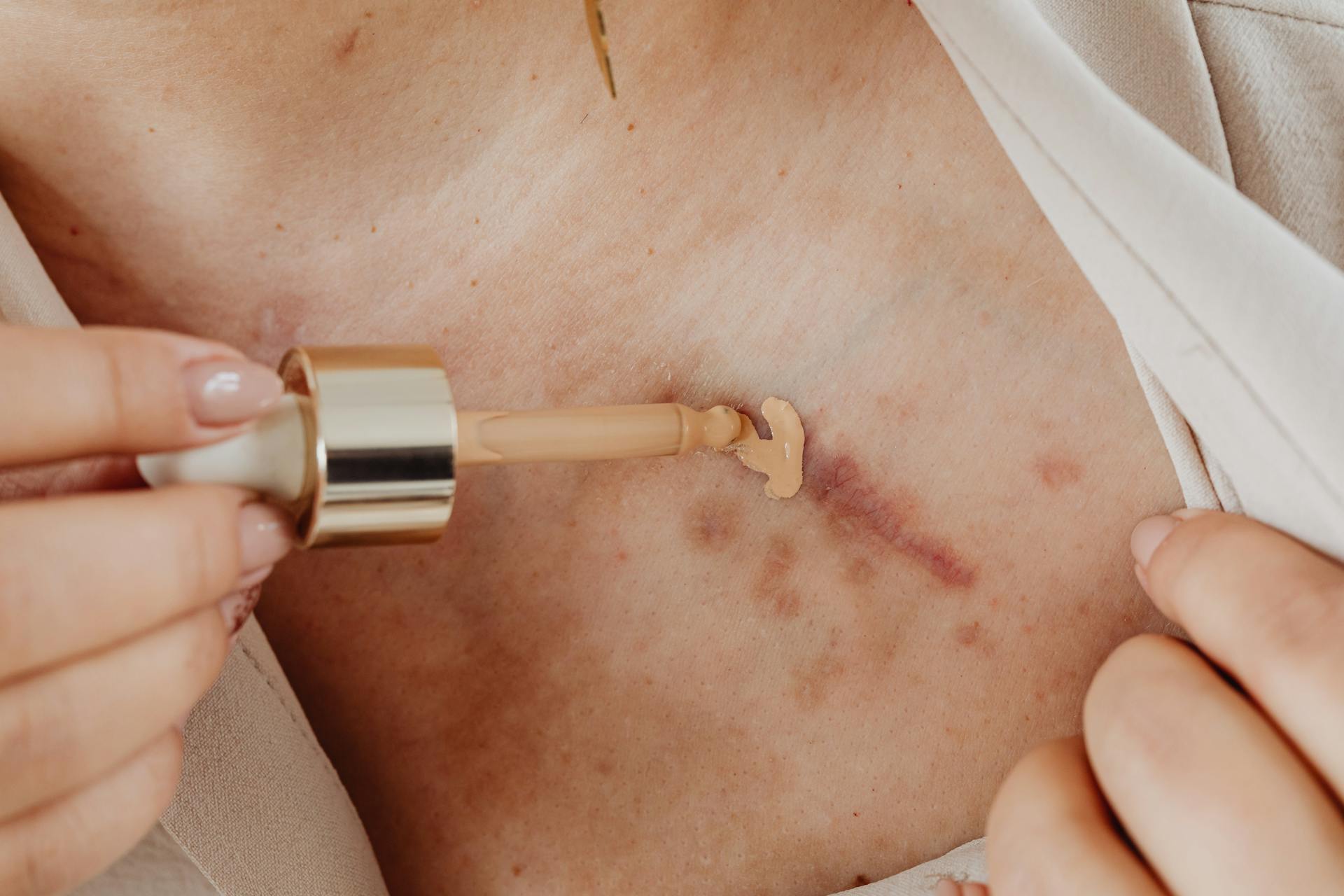 A Person Applying Concealer on Scar Using a Dropper