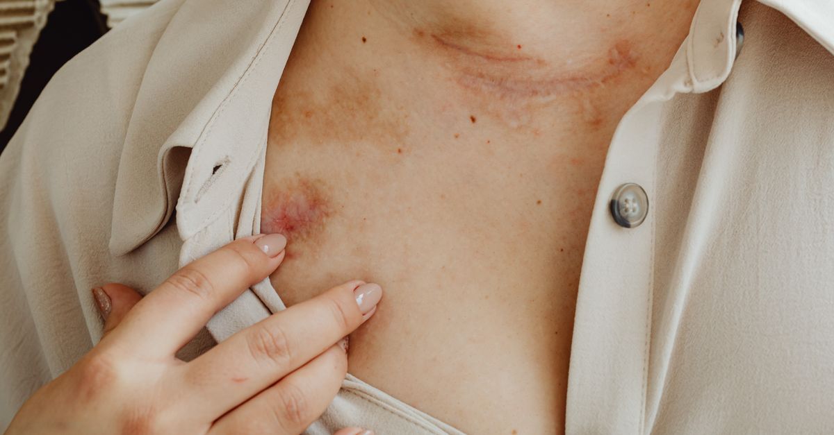 hodgkin lymphoma