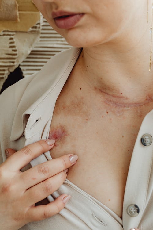 Close-up of Woman Showing Her Scars and Bruises on Her Neck and Chest 