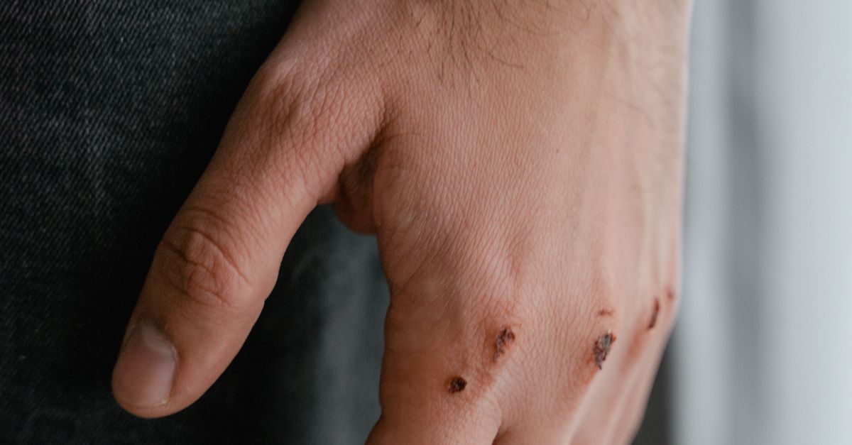 Close-Up Shot of Wound on a Person's Hand · Free Stock Photo