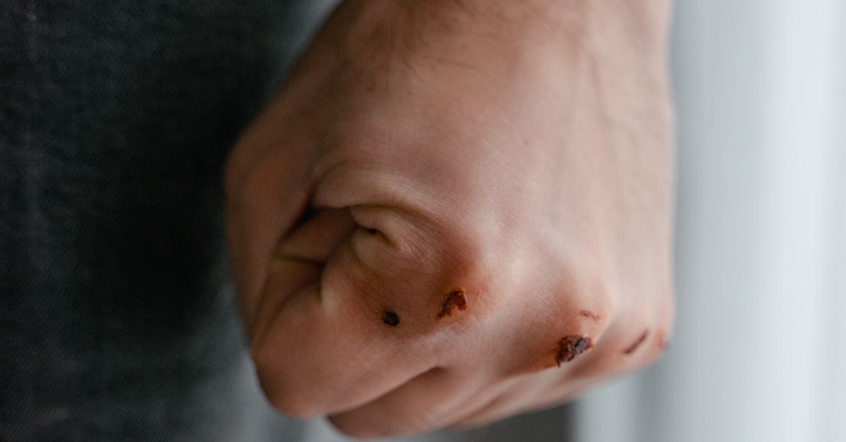 Close-Up Shot of Wound on a Person's Hand · Free Stock Photo