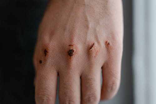 Free Wounded Knuckles Stock Photo