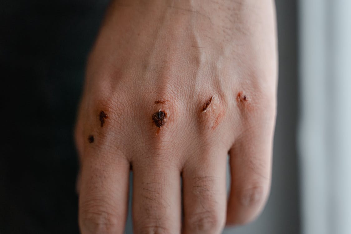 Human Skin Condition on Right Hand