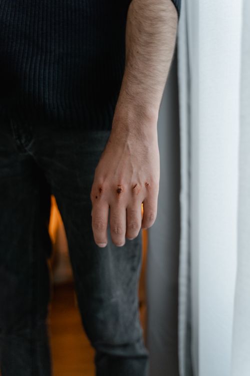 Free Close-up of a man's hand with visible wounds near a window indoors. Stock Photo