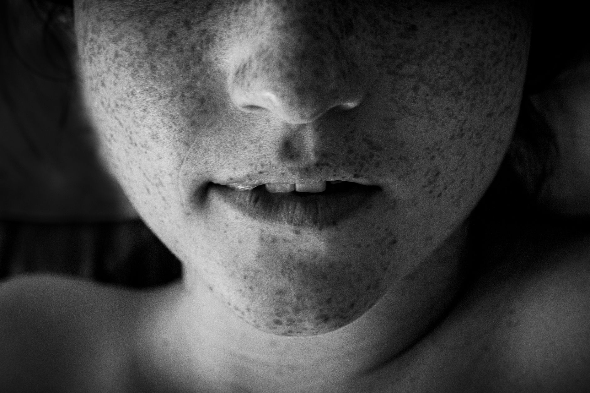 Freckles: Understanding Their Causes, Types, and When to Seek Medical Advice