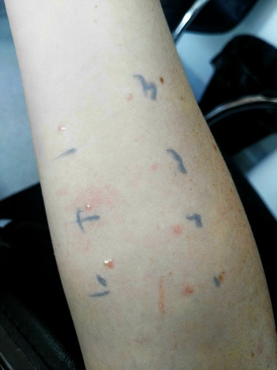Allergietest tattoofarbe hautarzt