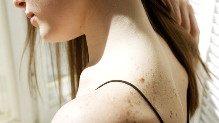 A Woman With Freckles At Her Back Shoulder