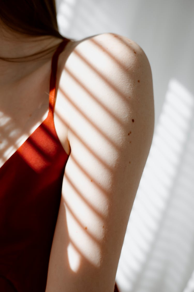 Shoulder Of A Woman With Moles