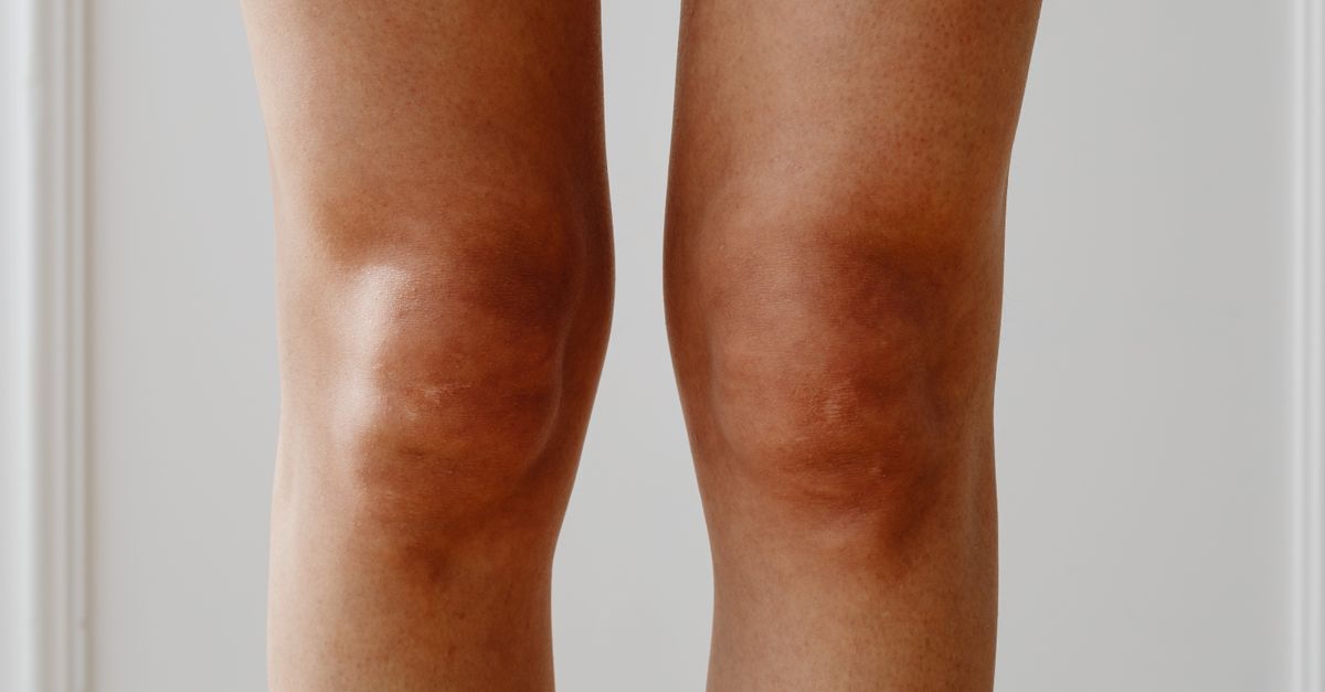 Why Does Inflammation Damage Joints