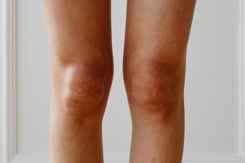 Free Close-up photograph of female knees with natural skin tone, emphasizing texture and health. Stock Photo