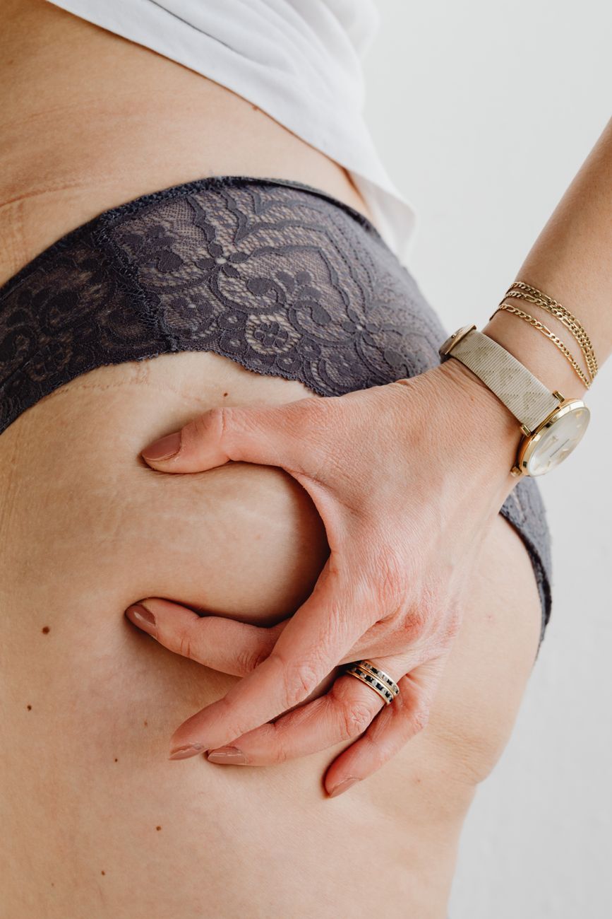 Cellulite, rilassamento o mancanza di volume? Cosa c'è dietro ogni lamentela sui glutei